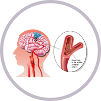 Stroke-Mediks-Srv